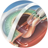 Катаракта в зависимости от вида ИОЛ Катаракта в зависимости от вида ИОЛ